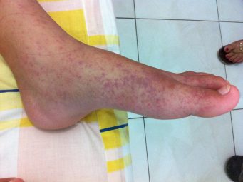 Detectan un brote de fiebre chikunguña en el sureste de China, con casi 500 casos